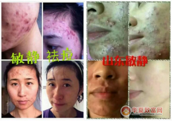 敏静痘敏斑连锁加盟